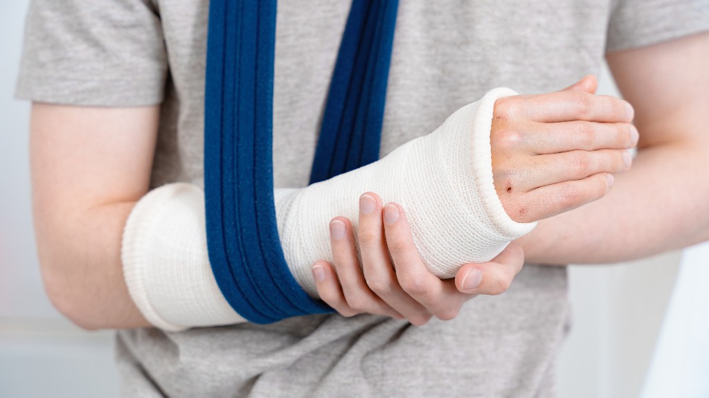 A person with a broken arm in a white cast